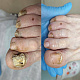 Семинар-практик «Онихогрифоз (утолщенные, деформированные ногти)»