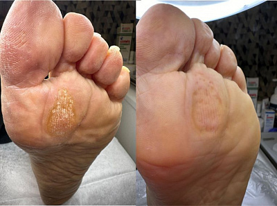 Специфические виды мозолей стоп: сосудистые, нейрофиброзные нейрососудистые и папиллярные - экспертный разбор