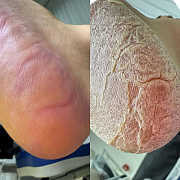 Мозоли и трещины